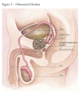 Obstructed Urethra